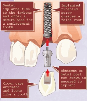 Dental Implants - Southwest Oral Surgery